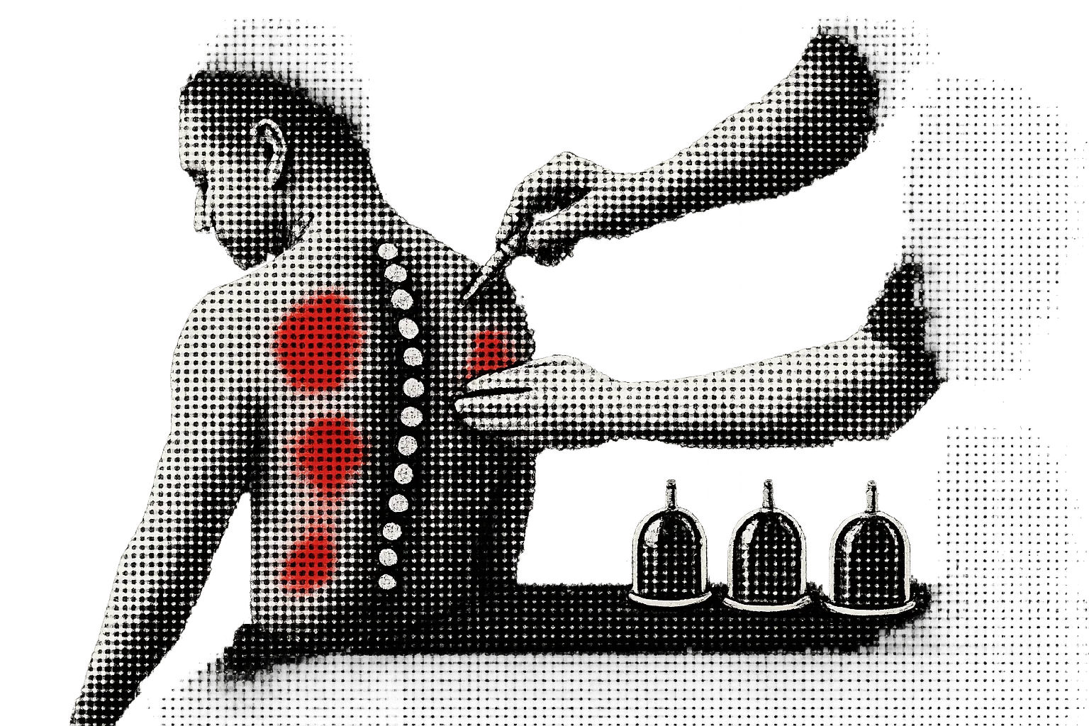 পিঠব্যথা ও মেরুদণ্ডজনিত সমস্যায় হিজামা থেরাপির কার্যকারিতা